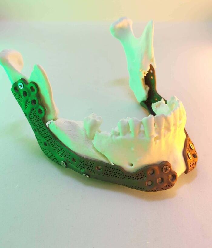 Реконструкція нижньої щелепи імплантат виготовлений на 3D-принтері 3Д протез щелепа роздроблена на частини рішення допомога відновлення щелепи