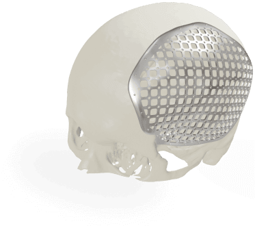 Виготовлення індивідуальних та серійних ендопротезів для хірургії, Титанові імпланти, краніопластика, як виглядає краніопластина, приклад вигляду краніопластини, надрукувати краніопластину Київ, напечатать краниопластину Украина