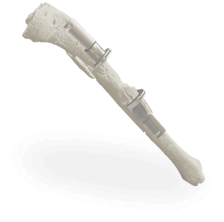 Навігаційний шаблон для медицини, резикційні та навігаційні шаблони, друк шаблонів Київ